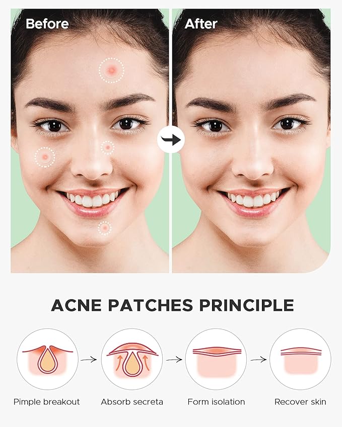 Pure Patch Acne Spot Cover